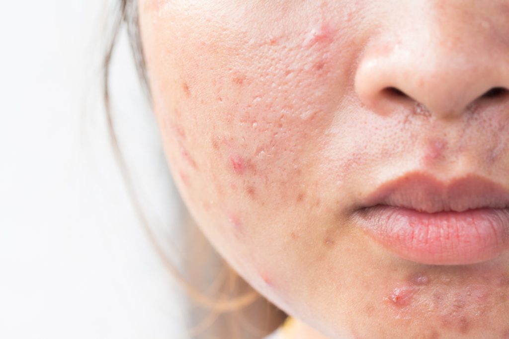 Skin care acne