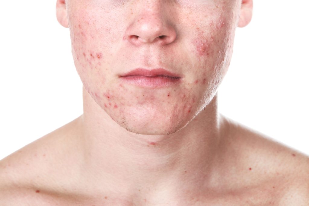 Address acne concerns with Ayana Dermatology & Aesthetics' expert skincare.