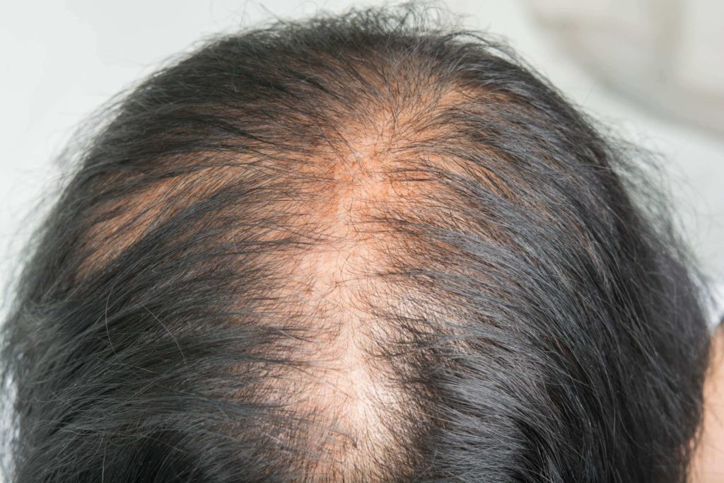 Combat hair loss effectively with Ayana Dermatology & Aesthetics treatment.