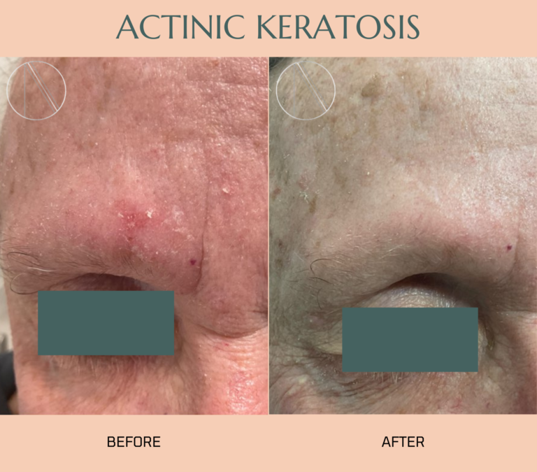 Treating actinic keratosis at Ayana Dermatology & Aesthetics.