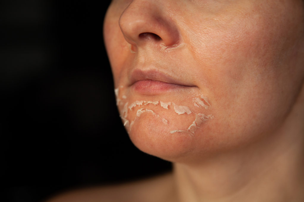 Skin peeling treatment showcasing rejuvenated complexion at Ayana Dermatology & Aesthetics.