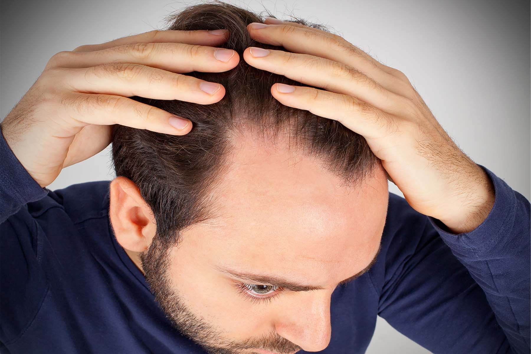 Hair Loss Treatment in fort lauderdale