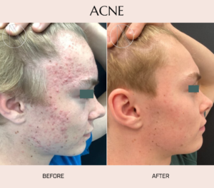Ayana Dermatology & Aesthetics tackles acne with cutting-edge solutions, revealing clear and confident skin transformations.
