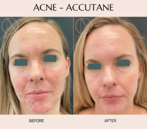 Ayana Dermatology & Aesthetics transforms skin with Acne-Accutane treatment, achieving clear and radiant complexion for confidence.