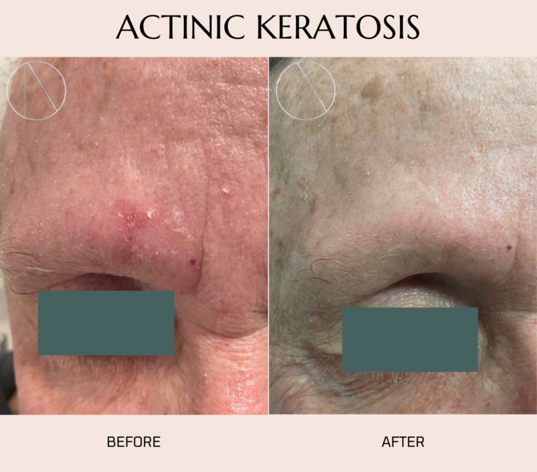 Actinic keratosis: sun-induced rough skin patches signaling potential skin cancer risk.