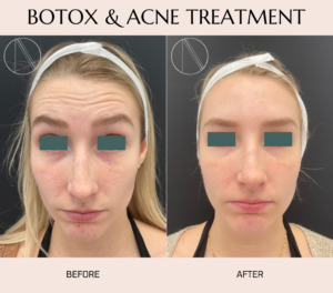 BOTOX & ACNE TREATMENT by ayana dermatology & aesthetics