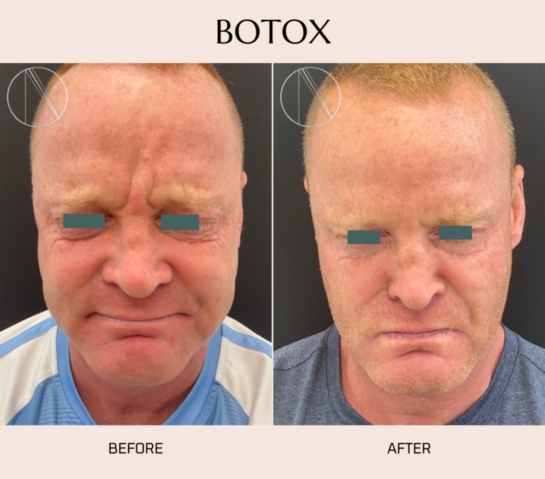 Ayana Dermatology & Aesthetics showcases the transformative effects of Botox, achieving smoother, more youthful skin naturally.