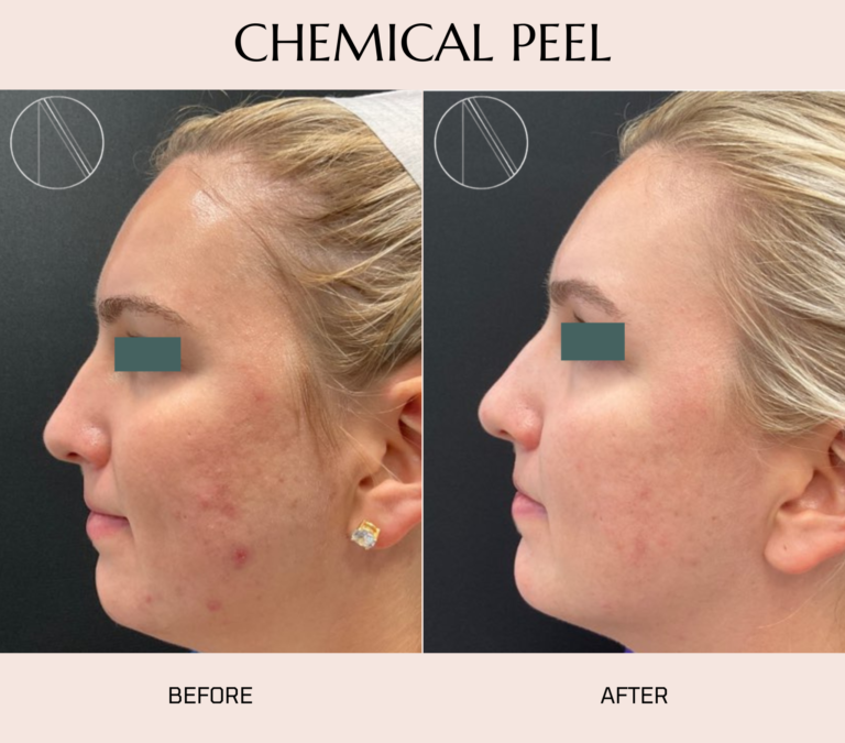 Ayana Dermatology & Aesthetics reveals radiant skin with the transformative effects of a Chemical Peel treatment.
