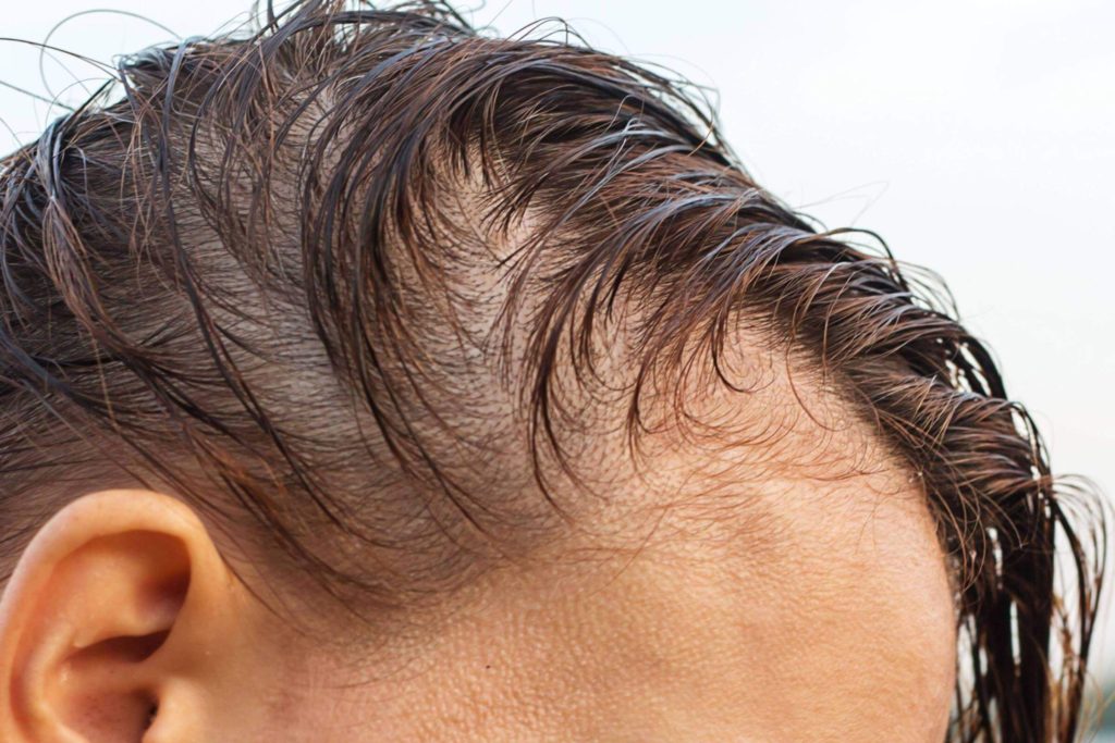 You are currently viewing Are There Any Side Effects of Keralase Hair Treatment?