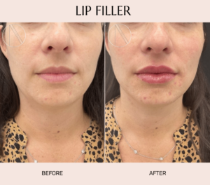 Ayana Dermatology & Aesthetics enhances lips with expert Lip Filler for natural fullness and enhanced beauty.