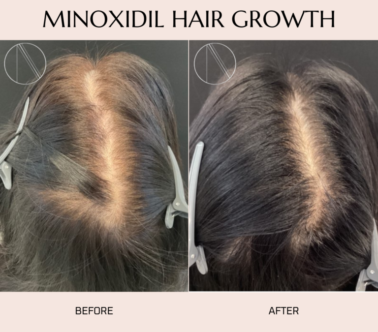 Ayana Dermatology & Aesthetics promotes healthy hair growth with Minoxidil, a proven solution for revitalized hair appearance.
