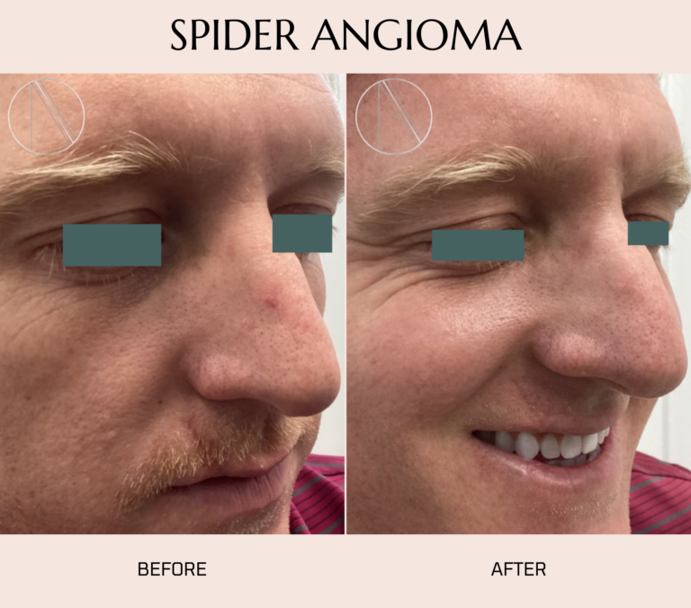 Spider angioma: red, spider-like skin lesion signaling potential liver or hormonal issues.