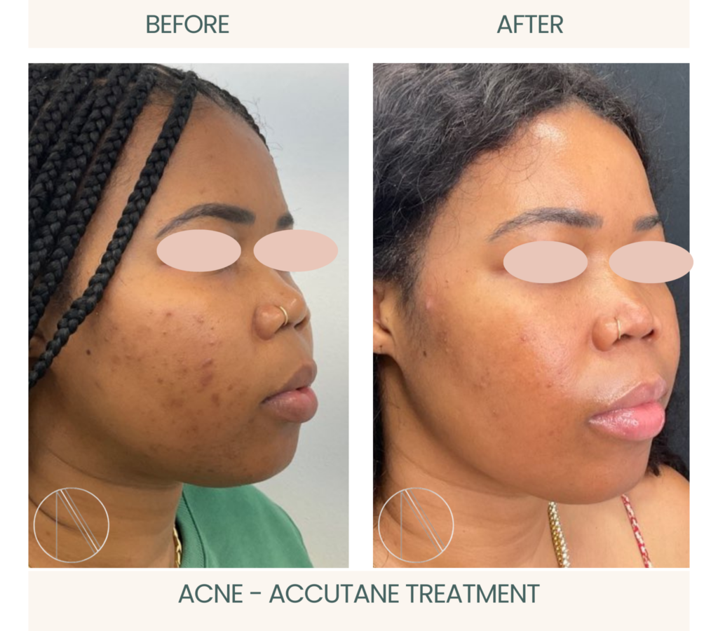 Ayana Dermatology & Aesthetics excels in Acne treatment, revealing the efficacy of Accutane for clear skin transformation.
