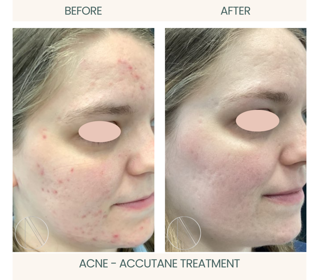 Ayana Dermatology & Aesthetics showcases successful acne treatment with transformative results using Accutane for clear skin.