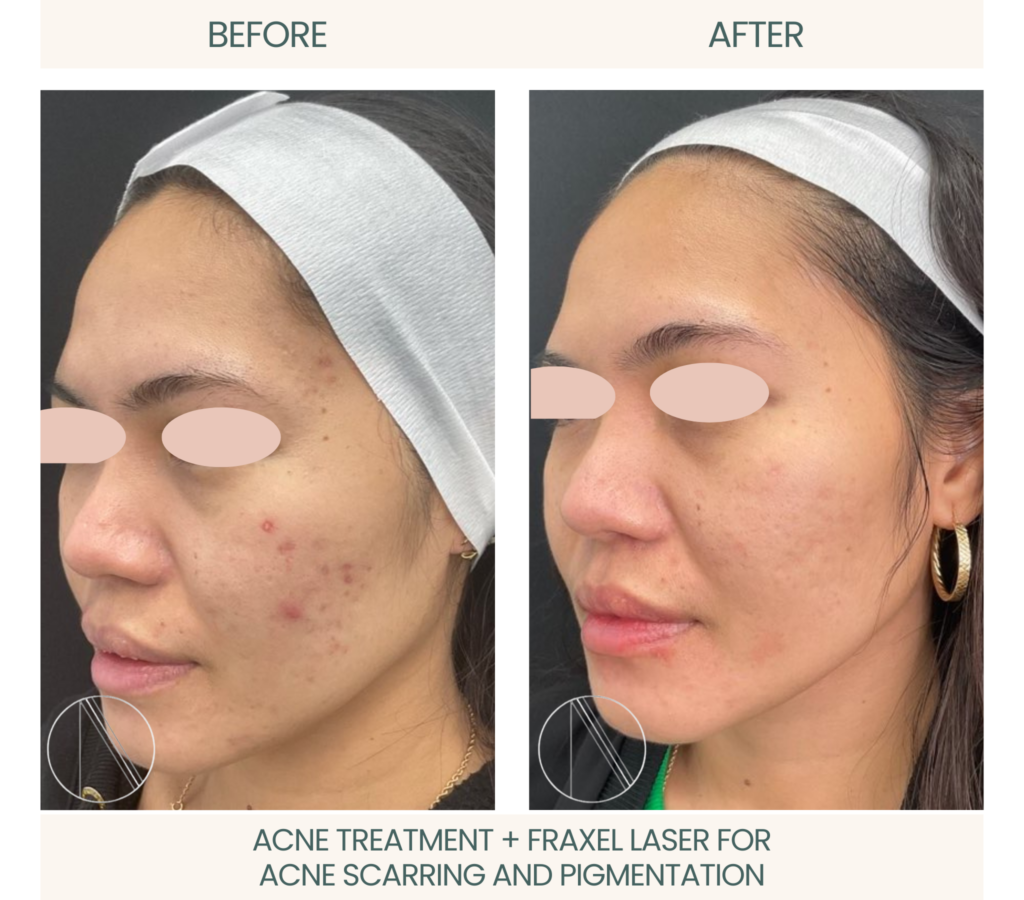 Ayana Dermatology & Aesthetics achieves clear skin with combined acne treatment and Fraxel laser for scarring and pigmentation.
