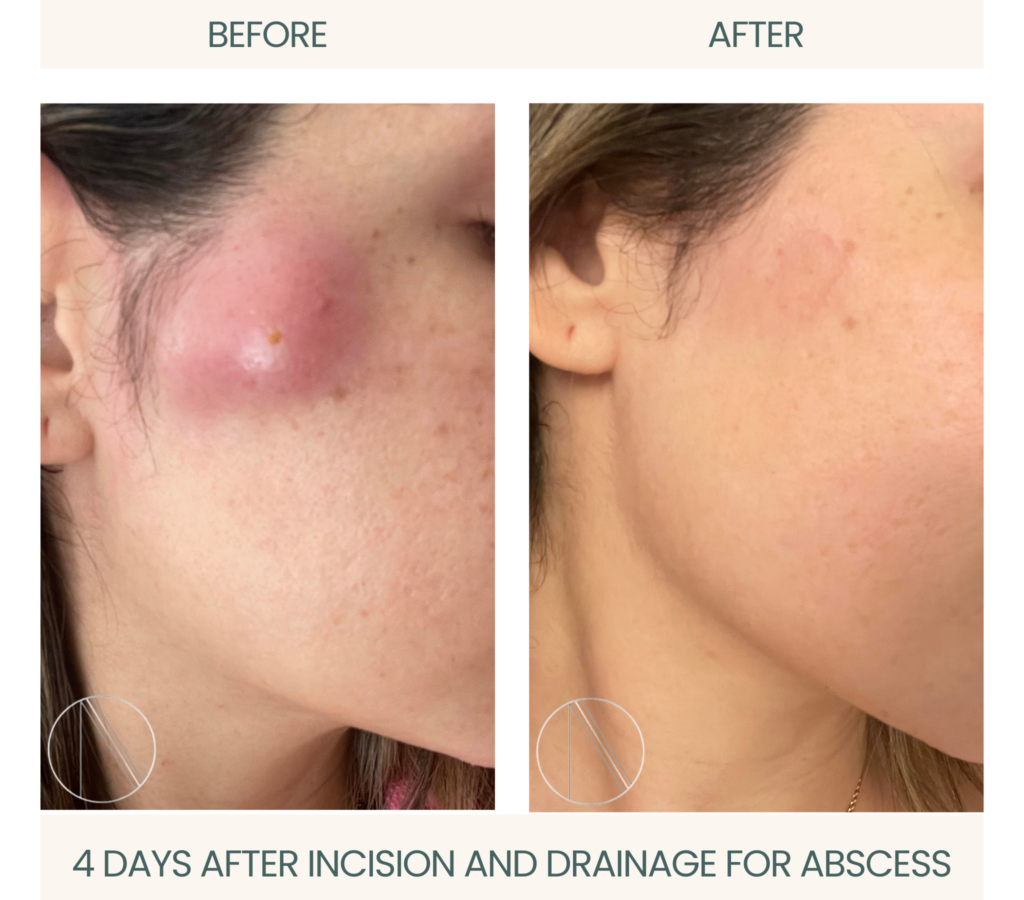 Ayana Dermatology & Aesthetics displays rapid healing, four days post incision and drainage for abscess treatment.