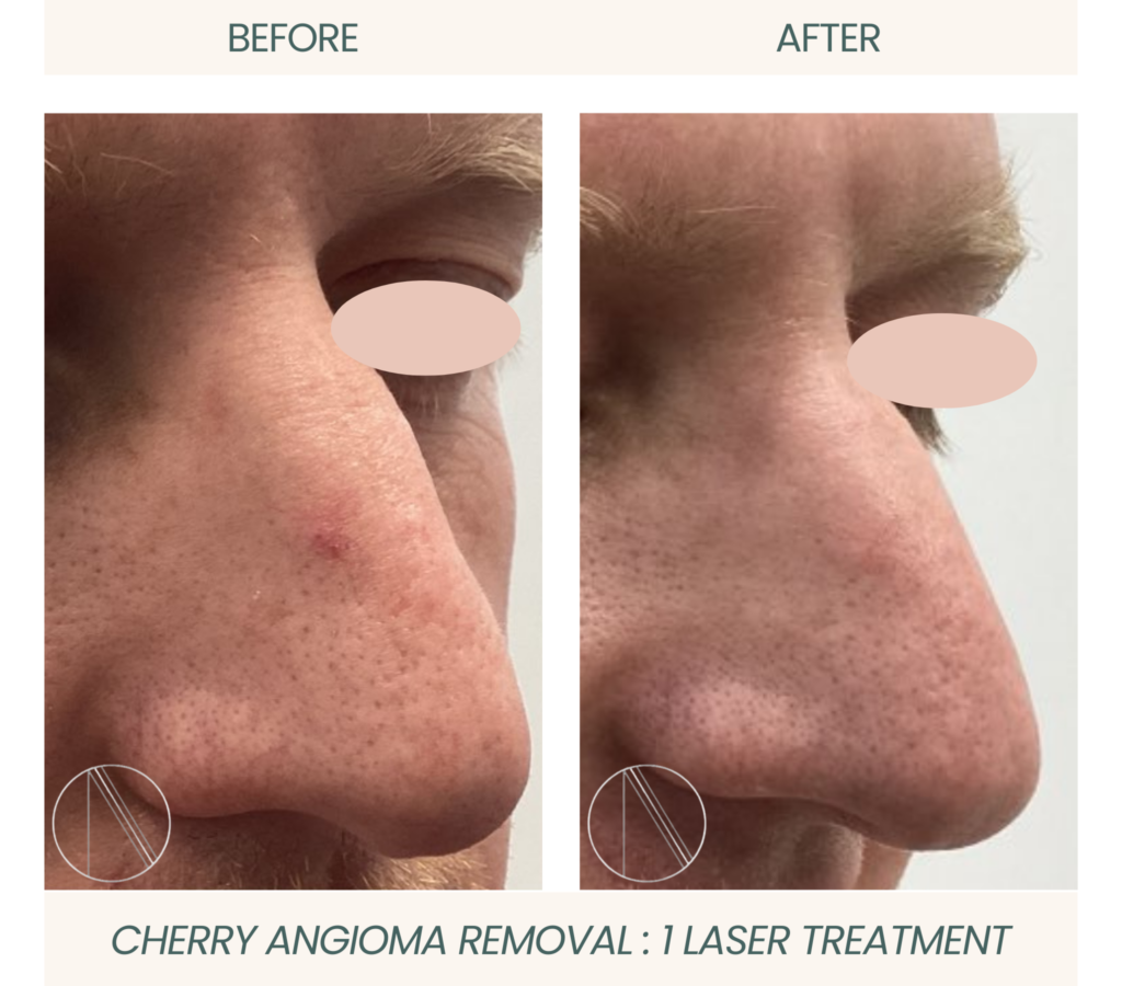 Ayana Dermatology & Aesthetics achieves one-time cherry angioma removal with precise laser treatment for flawless skin.