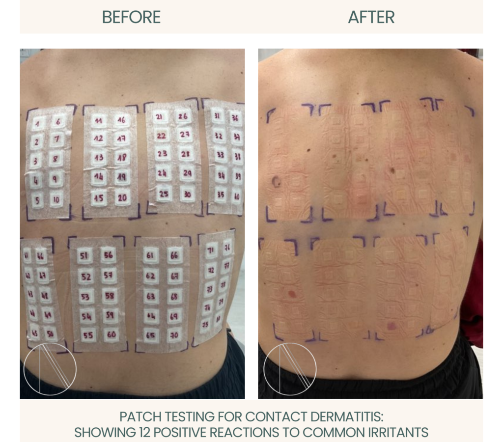 Ayana Dermatology & Aesthetics conducts patch testing, revealing 12 positive reactions to common irritants for targeted dermatitis care.
