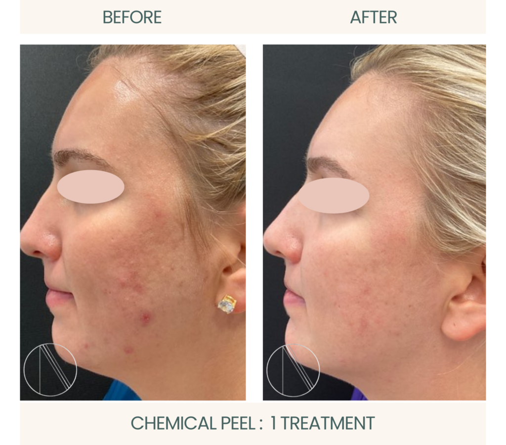 Ayana Dermatology & Aesthetics transforms skin with one powerful chemical peel treatment for radiant, rejuvenated results.
