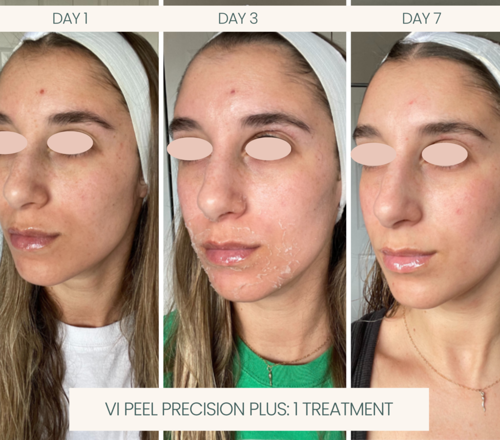 Ayana Dermatology & Aesthetics delivers skin perfection with a single VI Peel Precision Plus treatment.