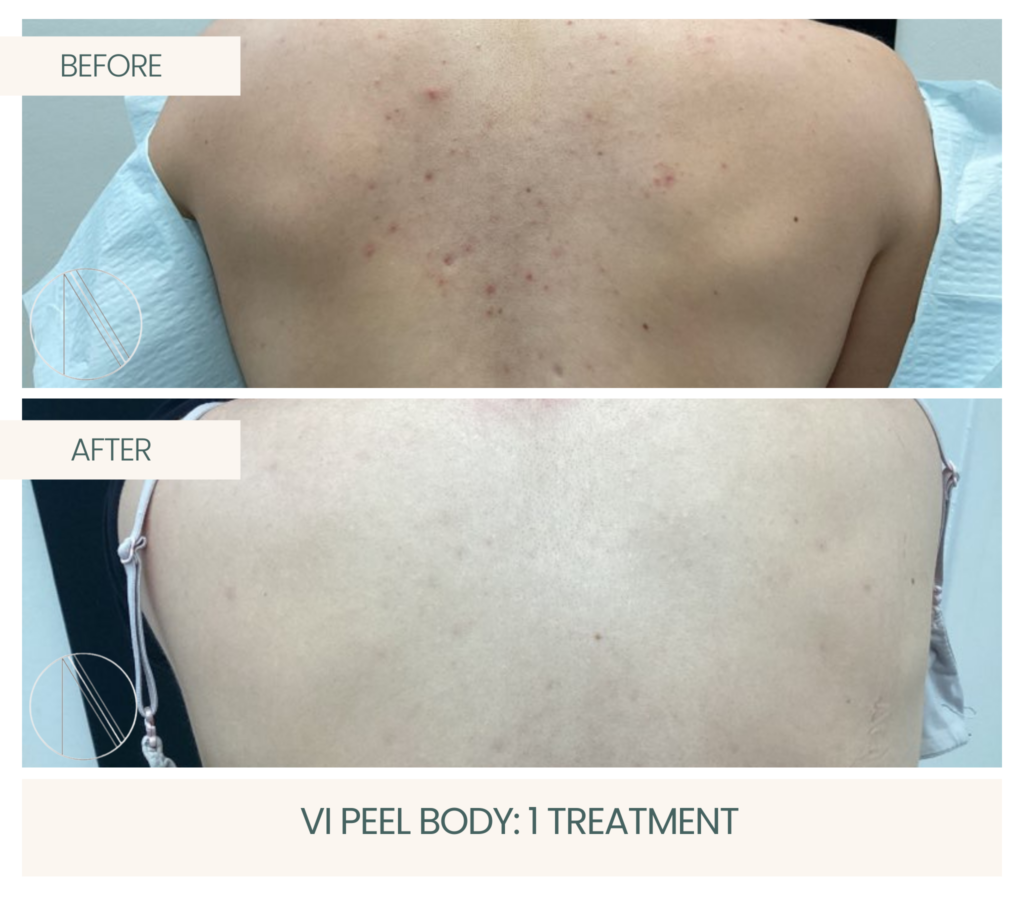 Ayana Dermatology & Aesthetics achieves skin renewal with a single Vipeel Body treatment for lasting transformation.