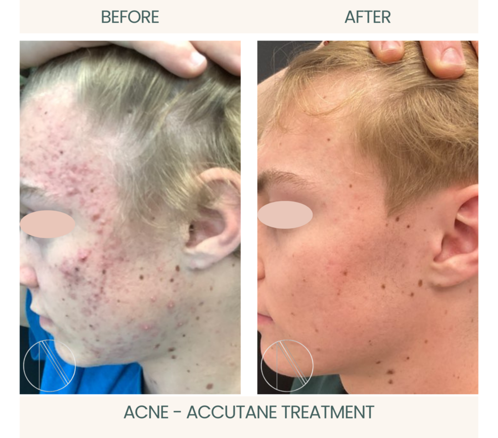 Ayana Dermatology & Aesthetics showcases Acne's remarkable before-and-after with successful Accutane treatment for clear, radiant skin.