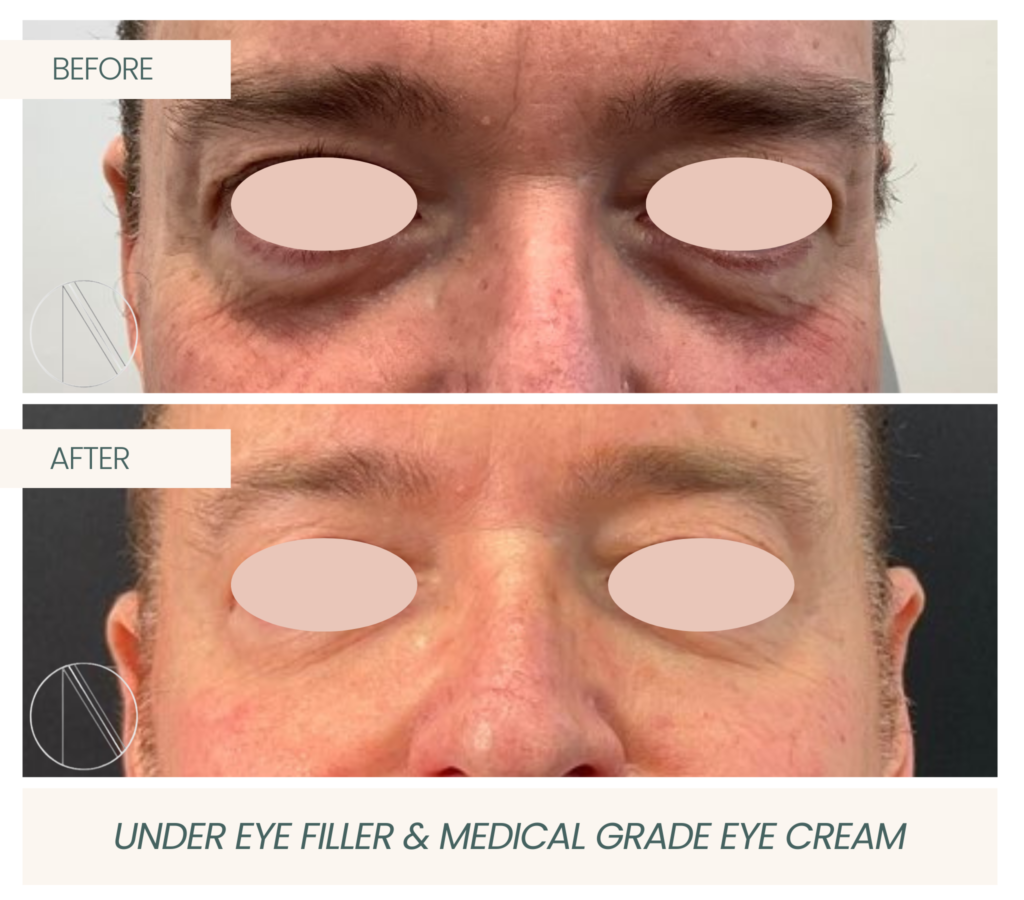 Ayana Dermatology & Aesthetics enhances under eyes with filler, complemented by medical-grade eye cream for rejuvenated radiance.