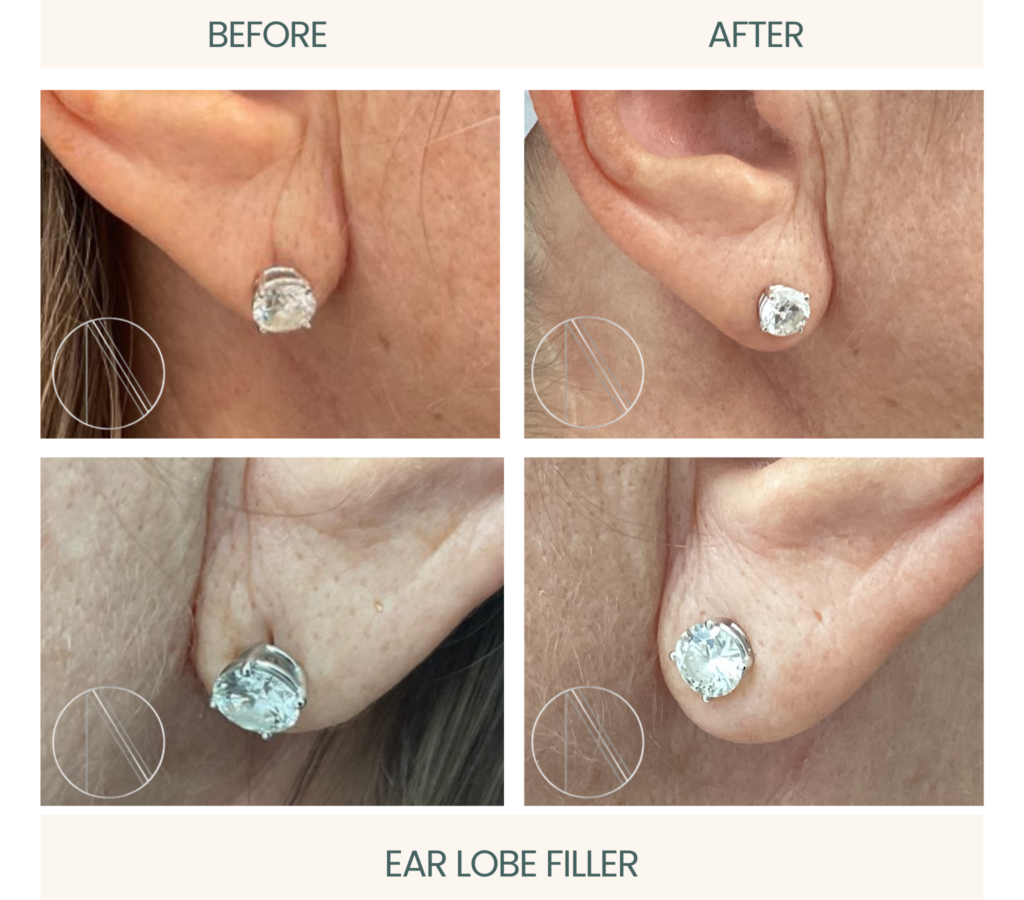 Ayana Dermatology: Active ear lobe filler procedure enhances volume for aesthetically pleasing, rejuvenated appearance.