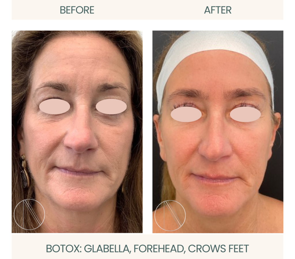 Botox treatment: Active reduction of glabella, forehead, and crow's feet lines, achieving smoother, youthful skin.