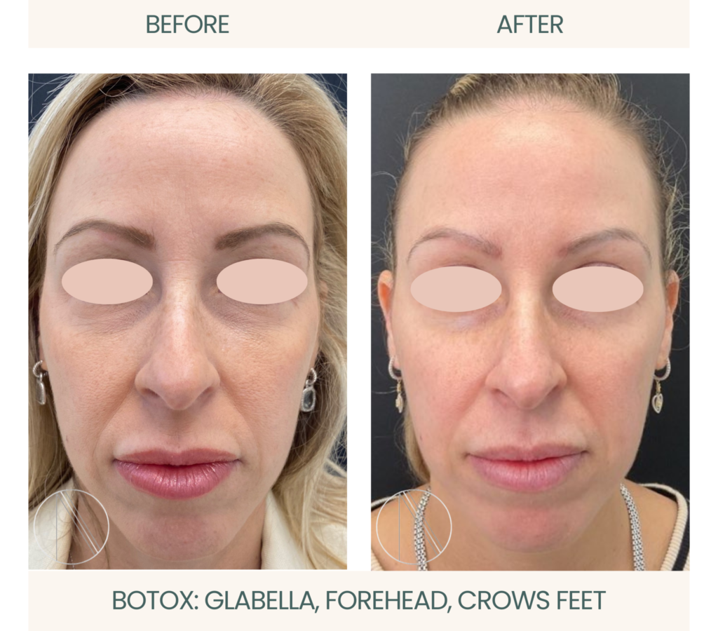 Botox treatment: Active smoothing of glabella, forehead, and crow's feet for a youthful, rejuvenated appearance.