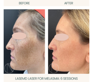 LASEMD Laser: Visible improvement after 6 sessions, effectively treating melasma for clearer, radiant skin transformation.