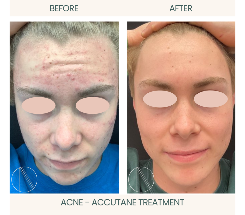Ayana Dermatology & Aesthetics showcases Acne transformation through impressive before-and-after images with effective Accutane treatment.