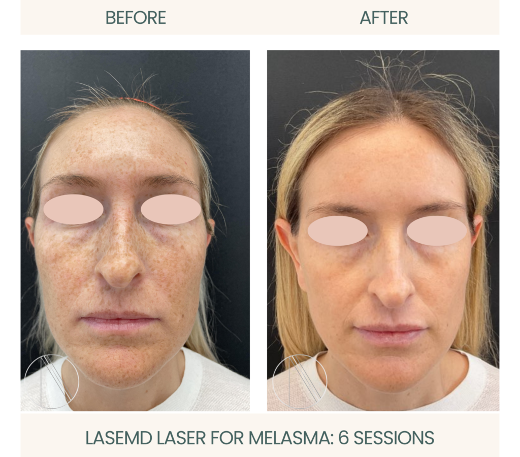 LASEMD laser triumphs over melasma in 6 sessions, unveiling even-toned, radiant skin in remarkable transformation.