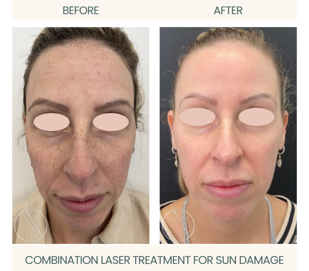 Ayana Dermatology & Aesthetics showcases sun damage transformation through active combination laser treatment for radiant, revitalized skin.