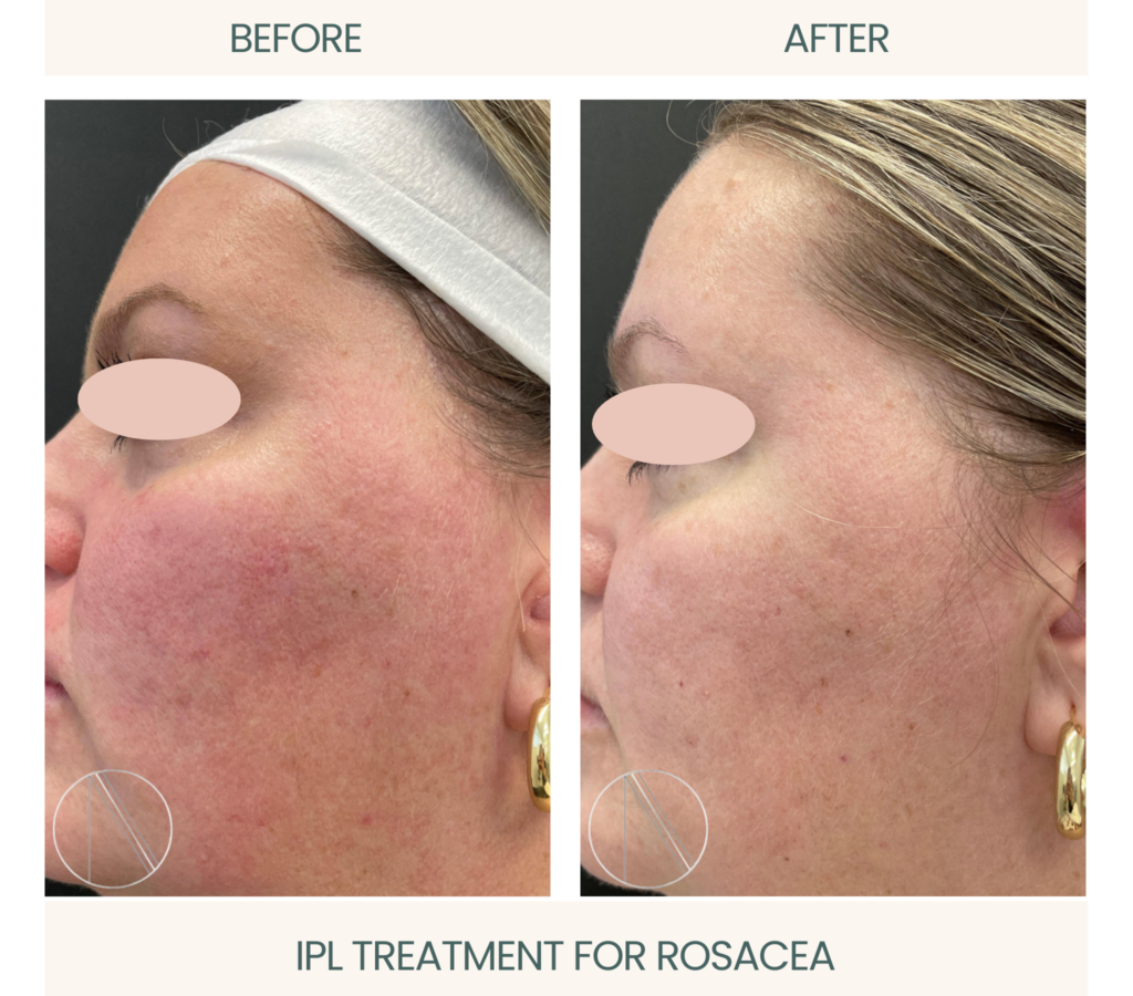 Ayana Dermatology & Aesthetics demonstrates effective IPL treatment for Rosacea, revealing clear and rejuvenated skin.