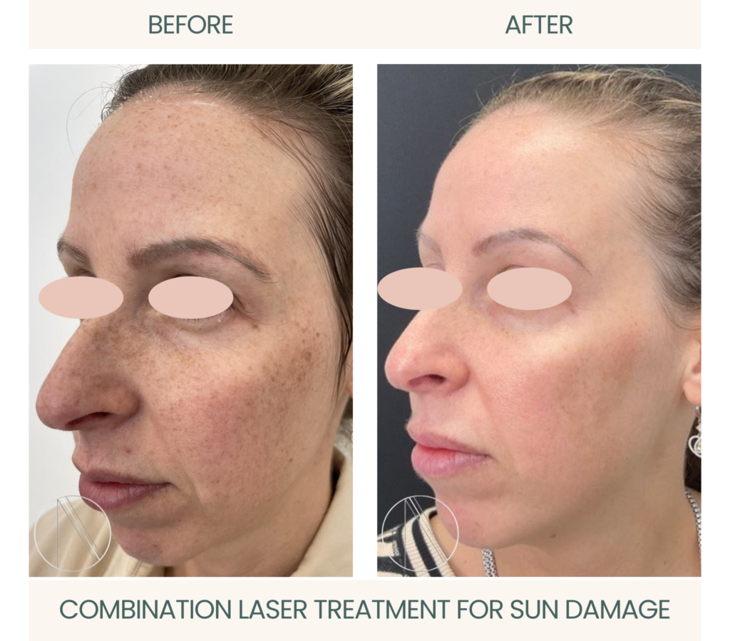 Active sun damage reversal through combination laser treatment showcased in compelling before-and-after photo.