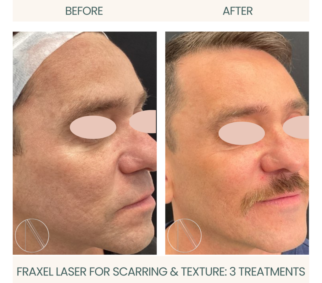 Dramatic improvement: Fraxel laser treatment visibly diminishes scarring and enhances skin texture in before-and-after comparison photo.