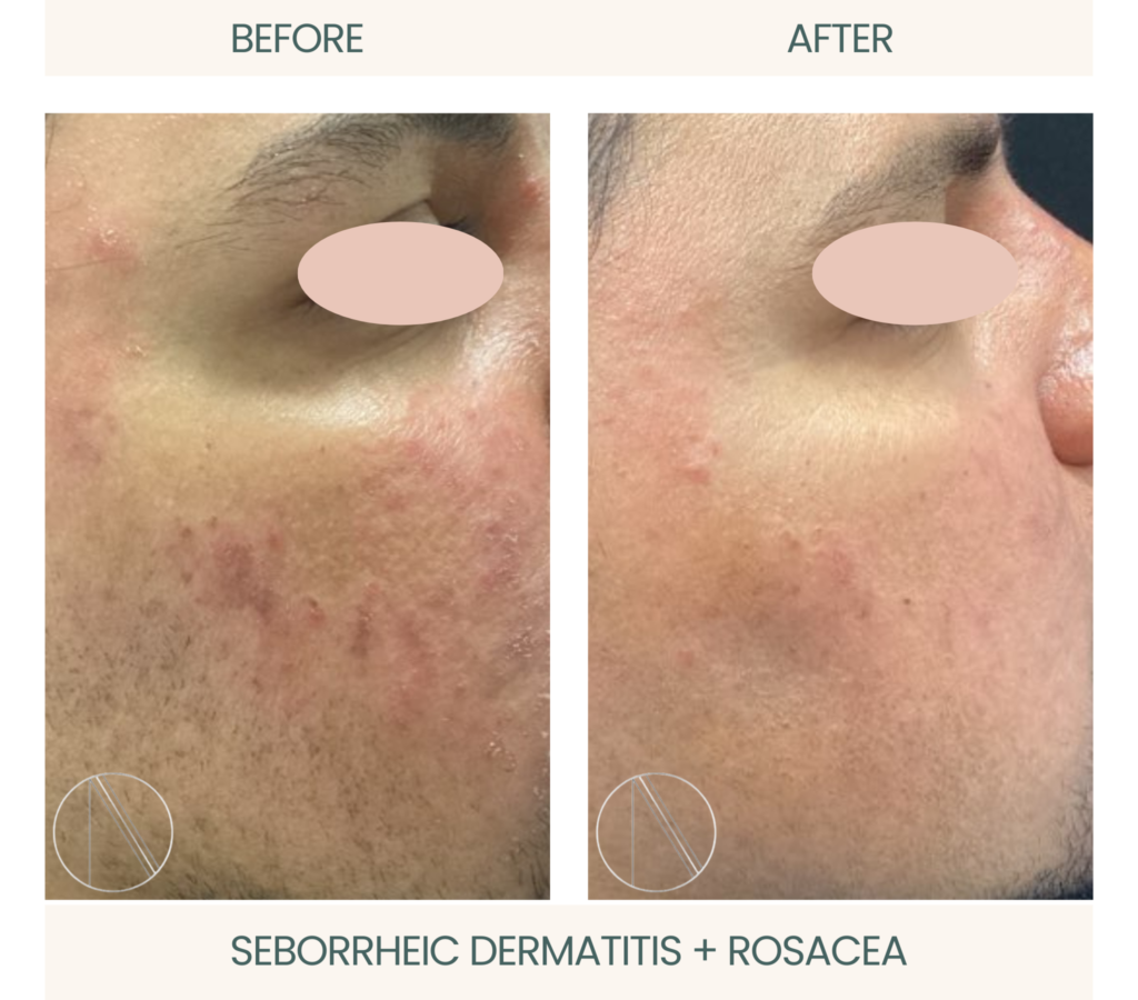 Transformative results: Active relief from Seborrheic Dermatitis and Rosacea in a compelling before-and-after comparison image.