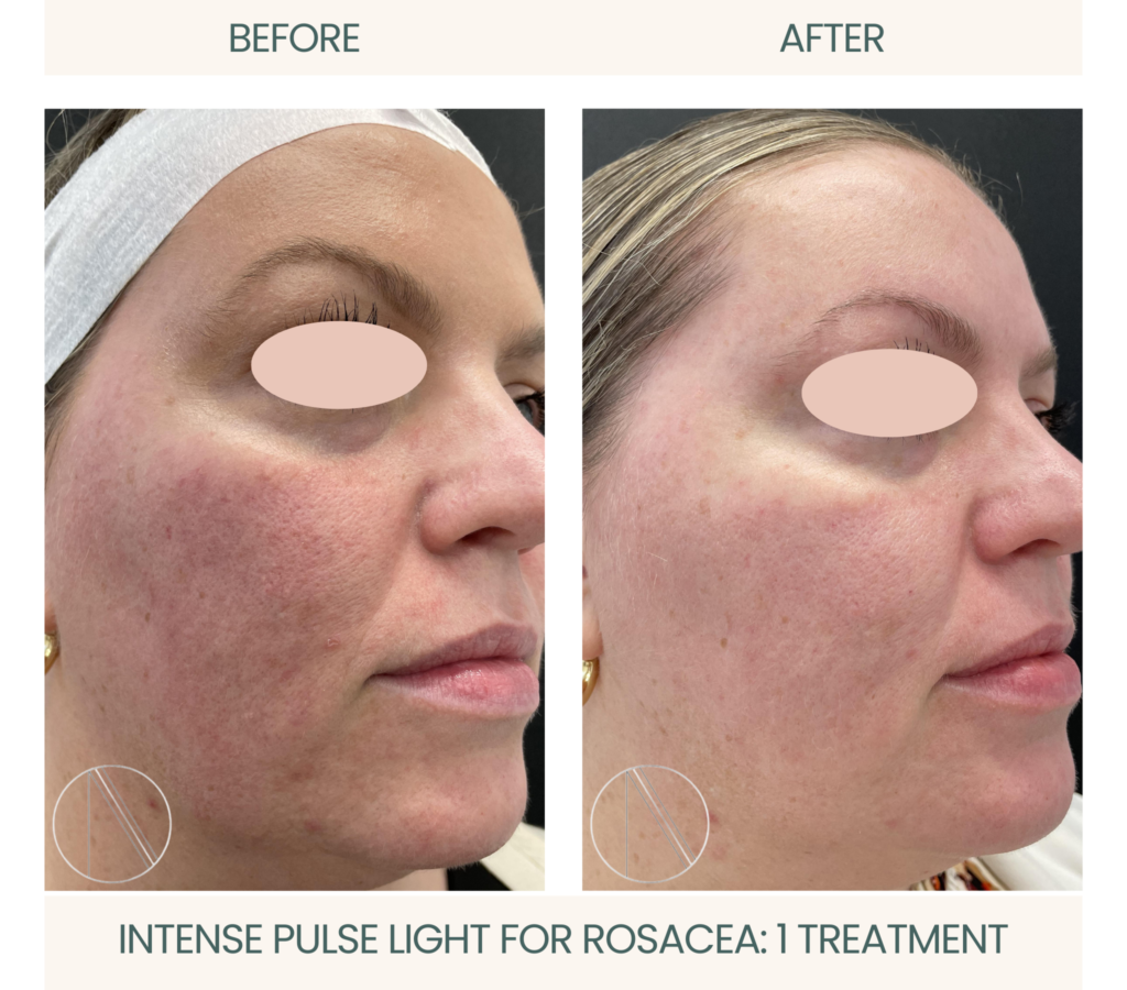 Ayana Dermatology & Aesthetics employs Intense Pulsed Light for active Rosacea treatment, ensuring clear, radiant skin.