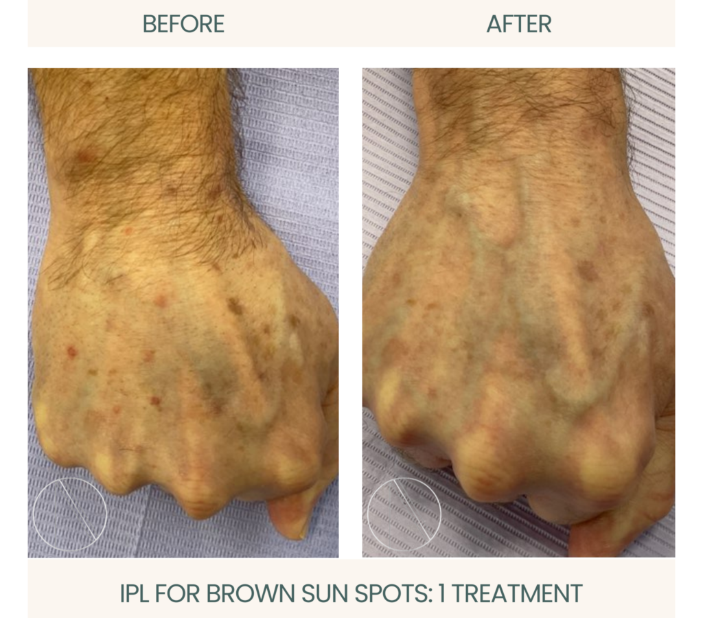 IPL treatment for brown sun spots, showcasing remarkable improvement in skin clarity at Ayana Dermatology & Aesthetics.