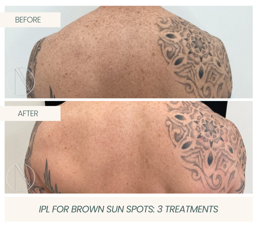 IPL for Brown Sun Spots, showcasing effective treatment for clearer, revitalized skin at Ayana Dermatology & Aesthetics.