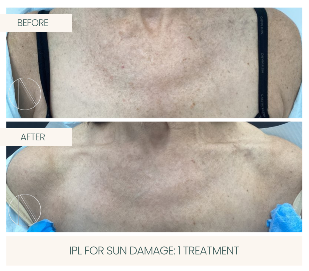 Transformative IPL treatment addressing sun damage, promoting rejuvenated and even skin tone at Ayana Dermatology & Aesthetics.