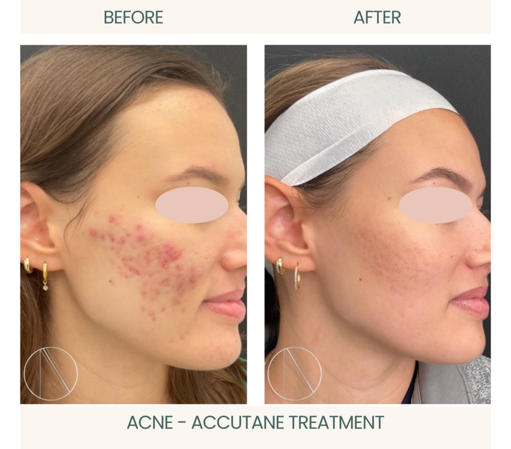 Ayana Dermatology & Aesthetics reveals stunning Acne before-and-after transformation with successful Accutane treatment for clear, radiant skin.
