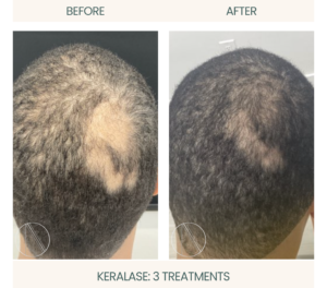 Ayana Dermatology & Aesthetics: Three Keralase treatments display enhanced hair regrowth.