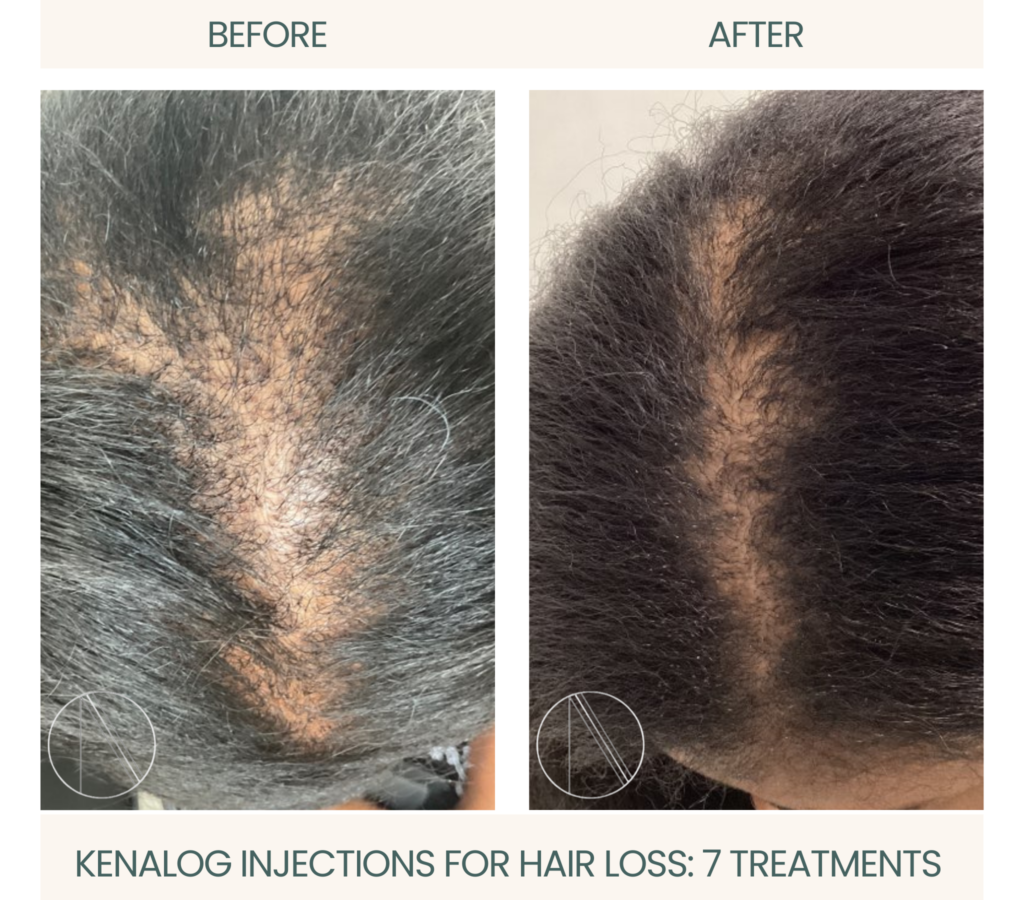 Hair loss treatment at Ayana Dermatology & Aesthetics goes beyond conventional options.