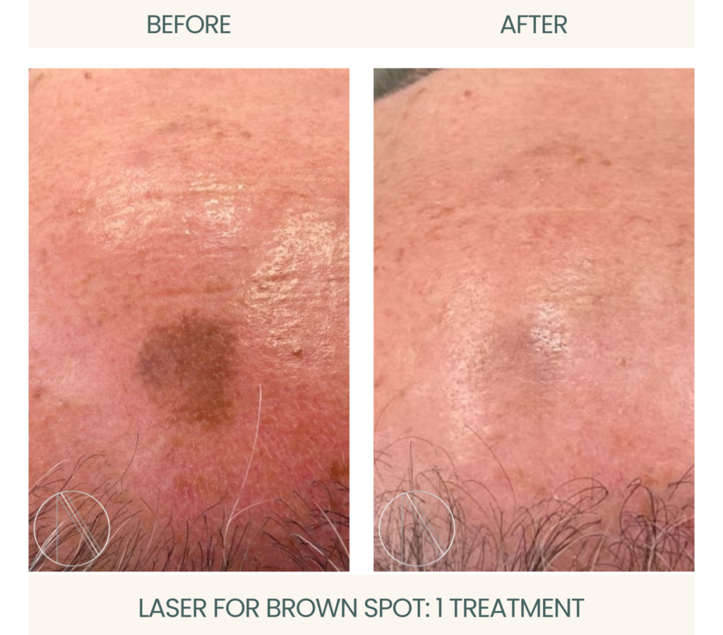 Ayana Dermatology & Aesthetics: Single treatment using Laser for Brown Spot, showcasing noticeable improvement in pigmentation.
