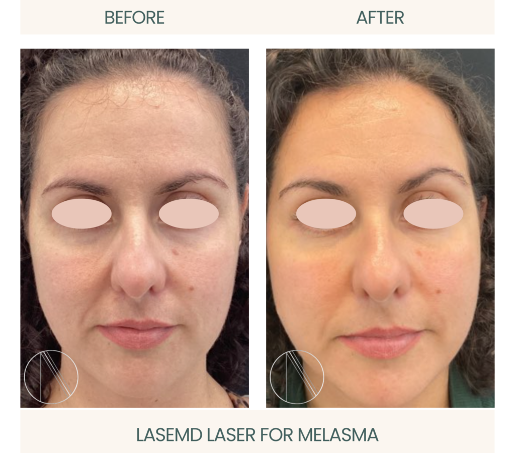 LASEMD Laser for Melasma at Ayana Dermatology & Aesthetics: Advanced treatment promoting even skin tone and clarity