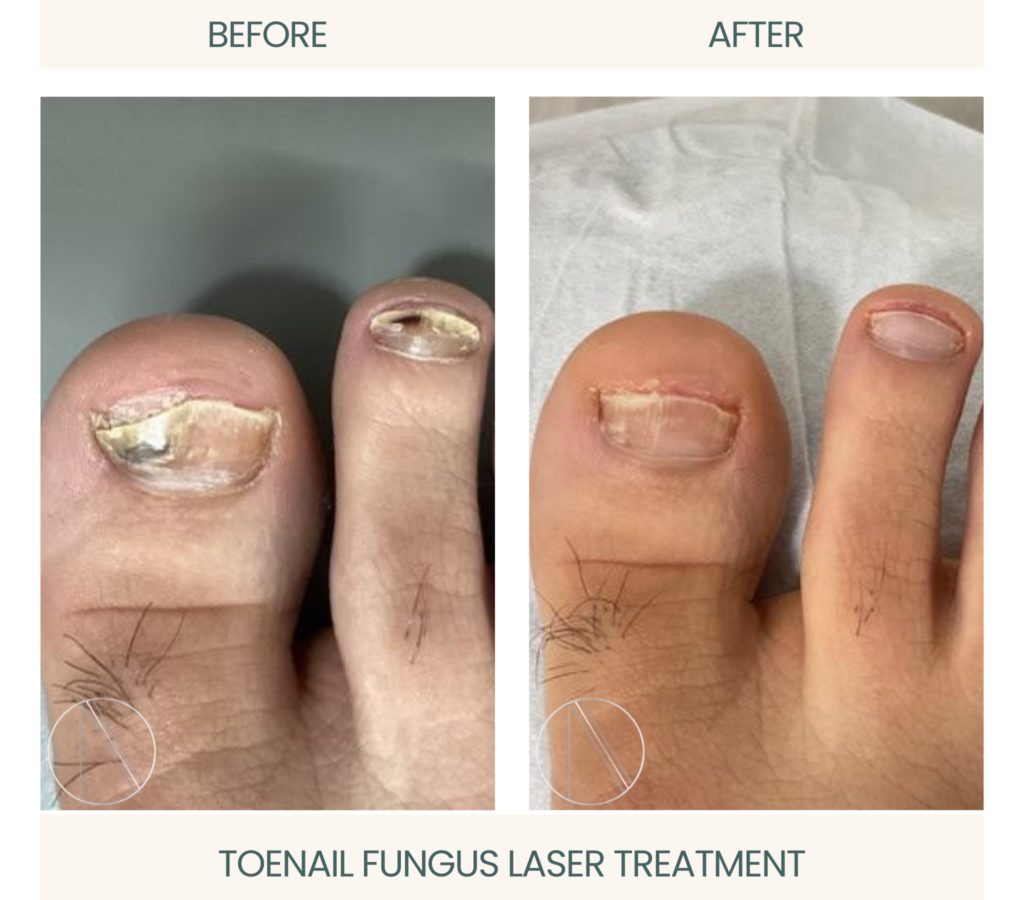 Toenail Fungus Laser Treatment: Transformative solution for healthy and clear nails through advanced medical technology.