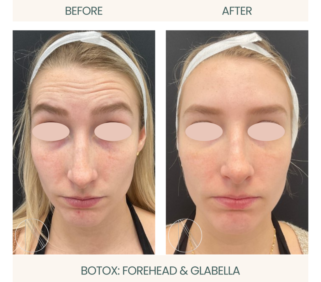 Botox treatment: Forehead & Glabella, displaying rejuvenated and smoother skin through advanced aesthetic procedures
