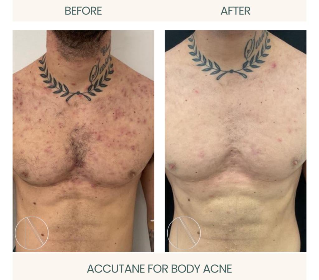 Transformation: Accutane for Body Acne Before and After Photo, depicting the effective impact on skin.
